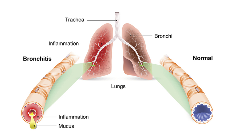 Acute Bronchitis