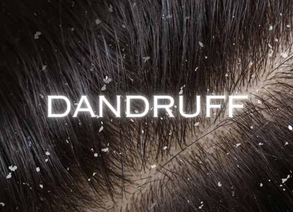 Dandruff
