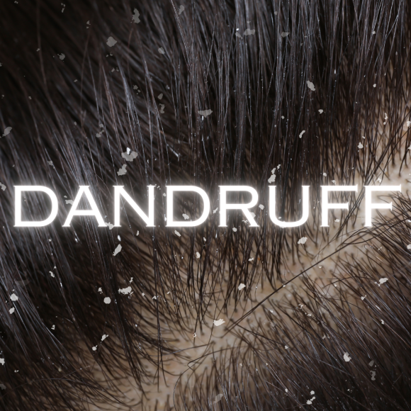 Dandruff
