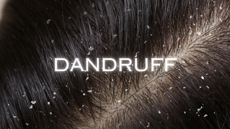 Dandruff