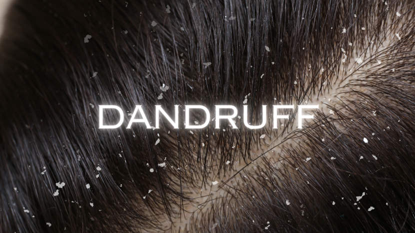 Top 10 Home Remedies for Dandruff That Actually Work Dandruff