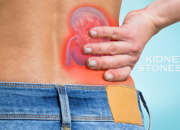 Kidney Stones