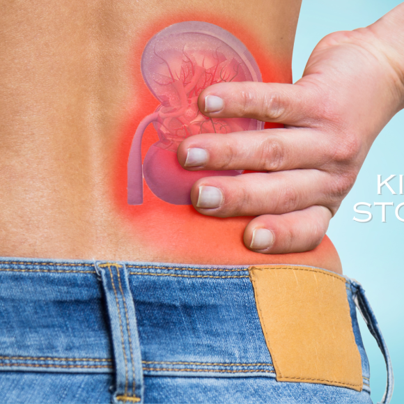 Kidney Stones