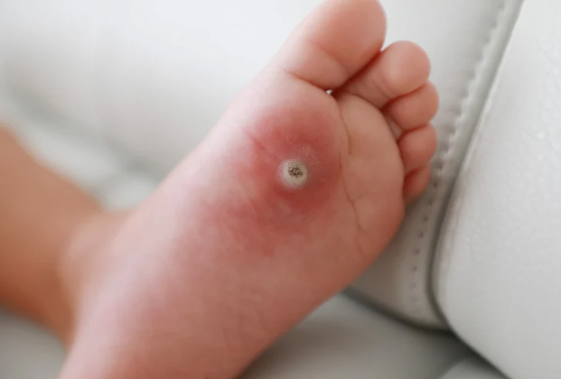 Warts on feet