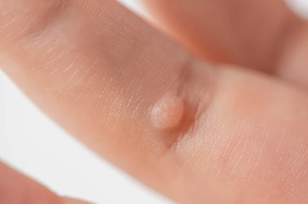 Warts on finger
